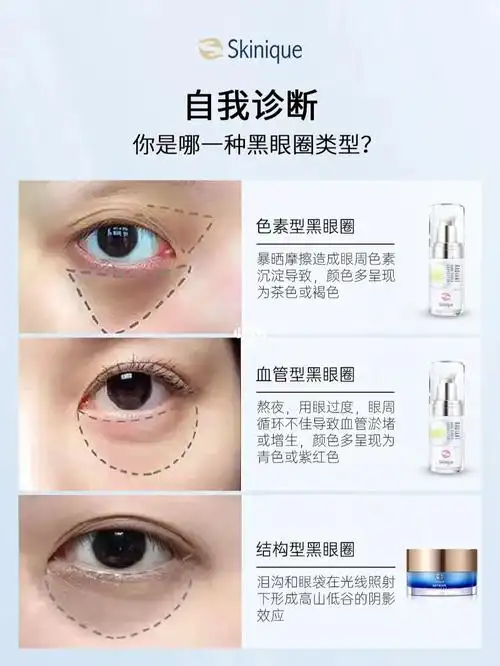 快来自测丨你的黑眼圈是什么类型