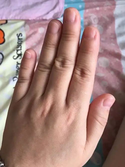 手指甲很扁怎么回事啊?需要补充什么 大拇指指甲还有点憋回去