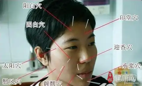 面瘫针灸图片详解