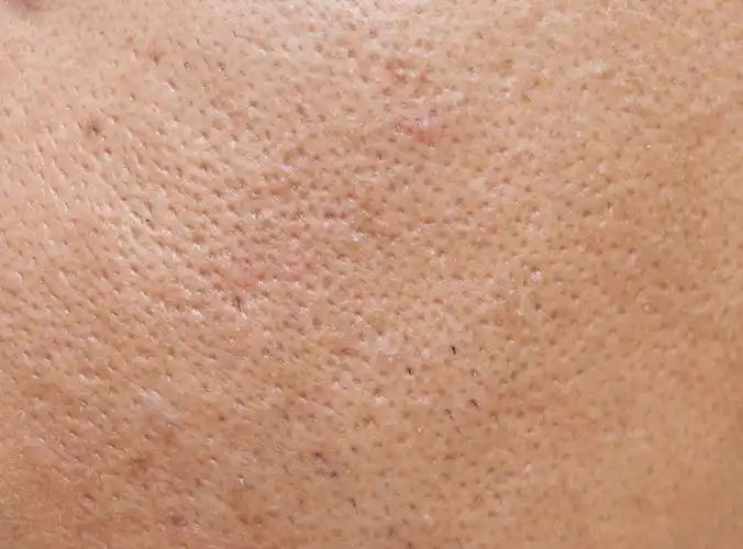 毛孔粗大如何缓解一定要注意这几点