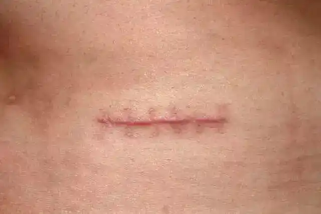 痘痕,擦伤,烧伤,手术伤……丑陋疤痕太头疼?