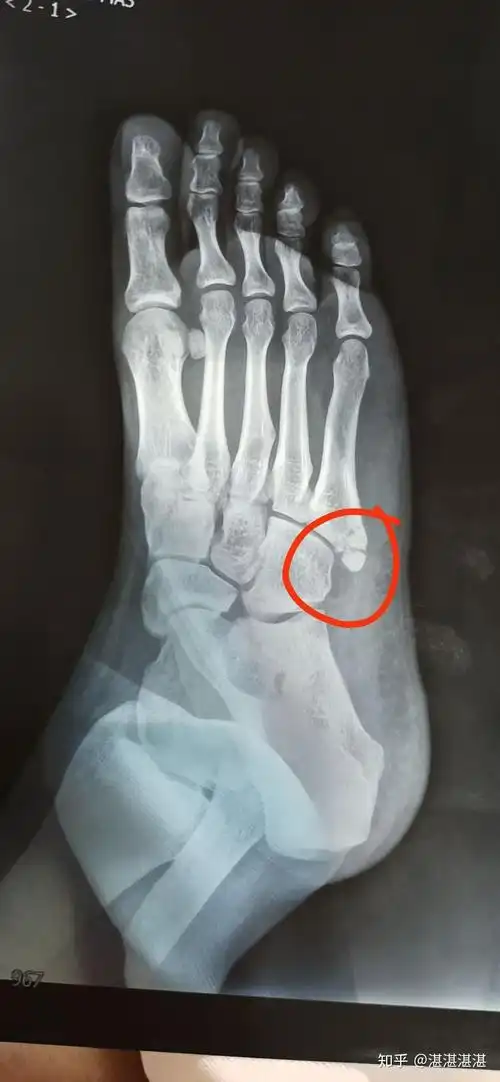 记录——右脚第五跖骨骨折的日子 - 知乎