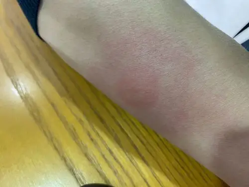 胳膊起来一个包,中间园园的,四周发硬发红,很痒?