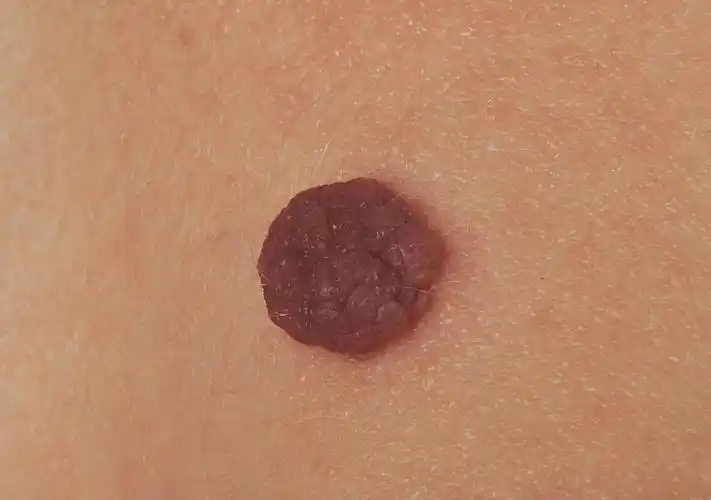 常见的皮肤疾病,俗称"瘊子",大部分人都长过,医学上一般称之为"疣"