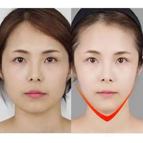 方脸怎么变成瓜子脸 认清这2点才能对症瘦脸