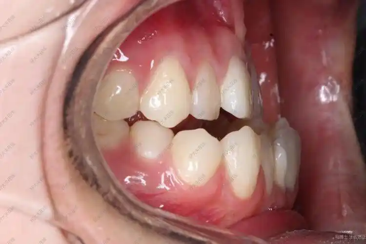 成人患者,严重骨性反合,上颌后缩,下颌前突,侧面凹面型,前牙反合,开合