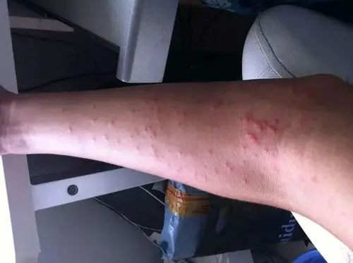 生病与皮肤病的关系