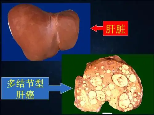第五节原发性肝癌.ppt 18页