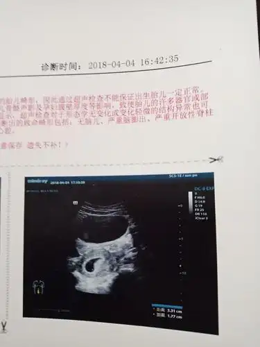 怀孕四十多天做的b超看孕囊长宽高能看男女?