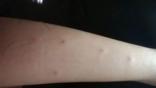 早上起来手臂上有很多小红点 不痛不痒