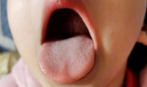 看孩子舌相是有神的好调还是无神的好调