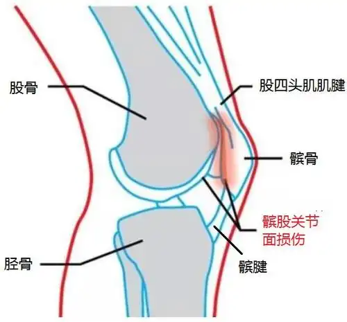 跑步后膝盖疼痛,警惕"跑步膝"