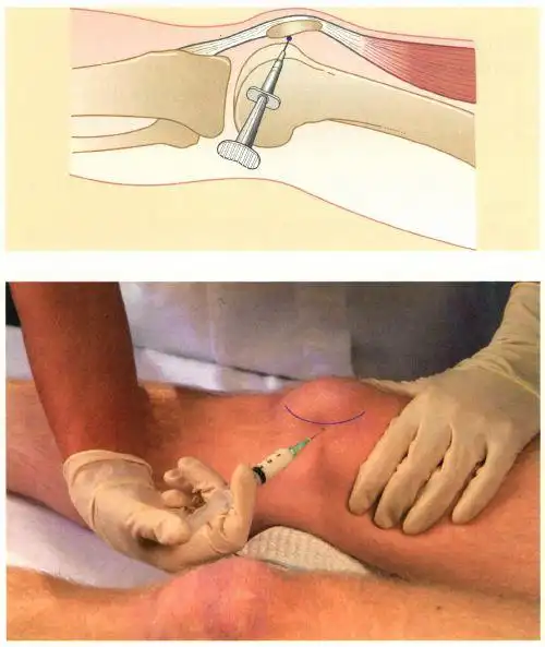 《镇痛注射技术图谱》——下肢注射技术:膝关节