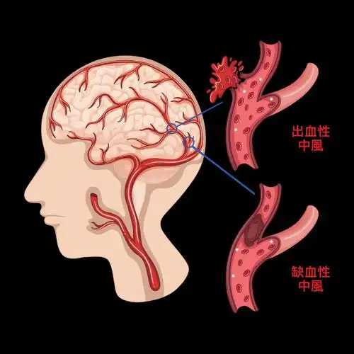 人到中老年,不得不服老,脑梗常发生,还得多看好.