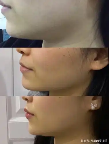 下颌线不清晰不一定因为胖!