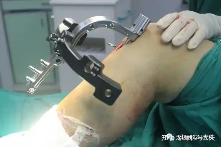 小腿骨折的微创手术--髓内钉固定术