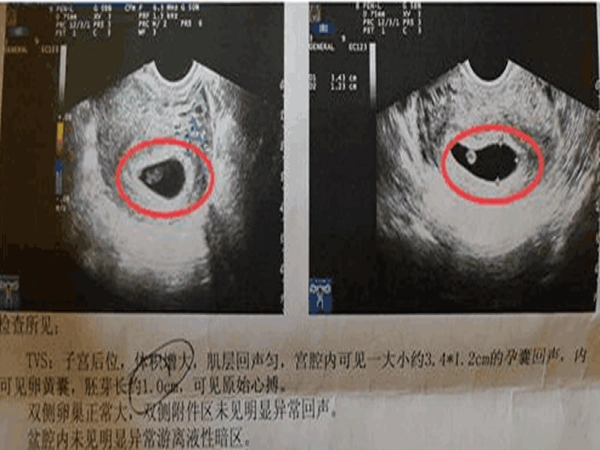 民间有传闻说长孕囊生男孩,圆孕囊生女孩,但实际上这种说法并不准确
