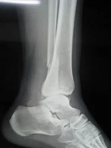 求助一例踝部骨折