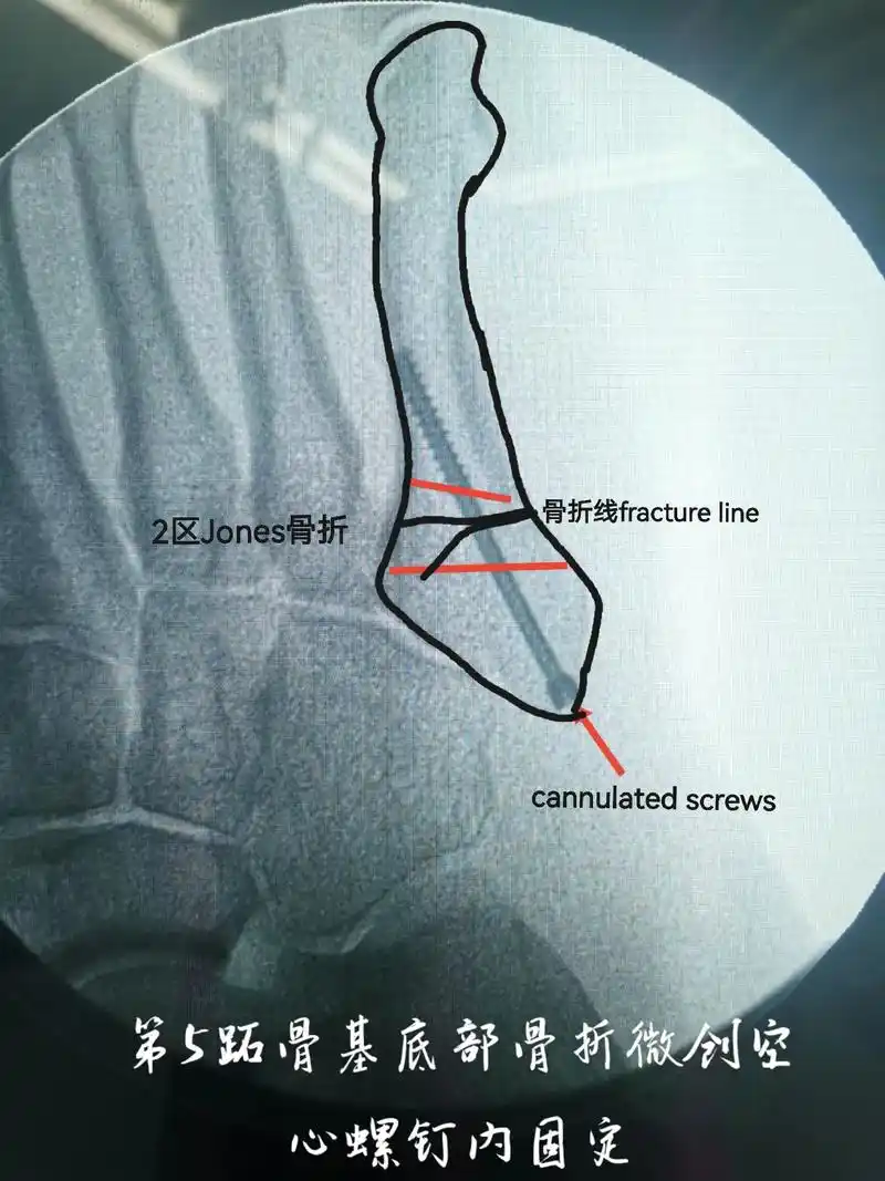 第5跖骨基底部骨折.骨头虽然不大,骨折了也会让人痛苦不堪.突 - 抖音