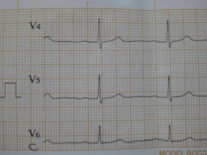 正常心电图看看