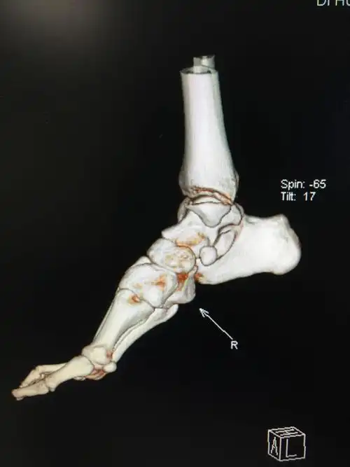 右内踝骨折提前三天口服艾瑞昔布100mgbid