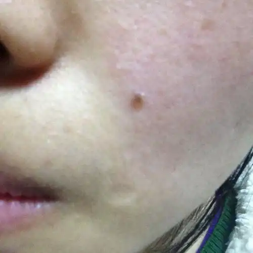 药水点痣两天,看着像起了一个小水泡,这是什么情况啊?