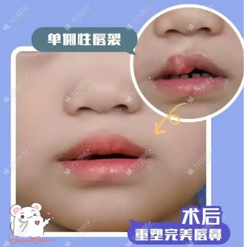 只要不是疤痕体质基本不会留疤 - 口唇整形 - 无忧爱美网