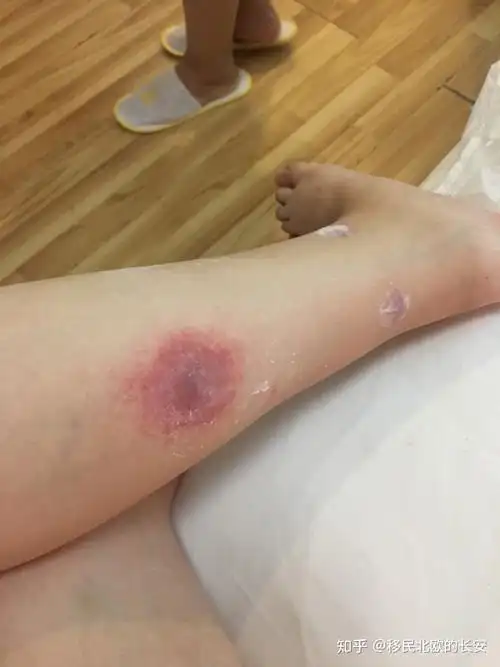 为什么有的人被蚊子咬后是起一个大包有的人则是出现一个红点