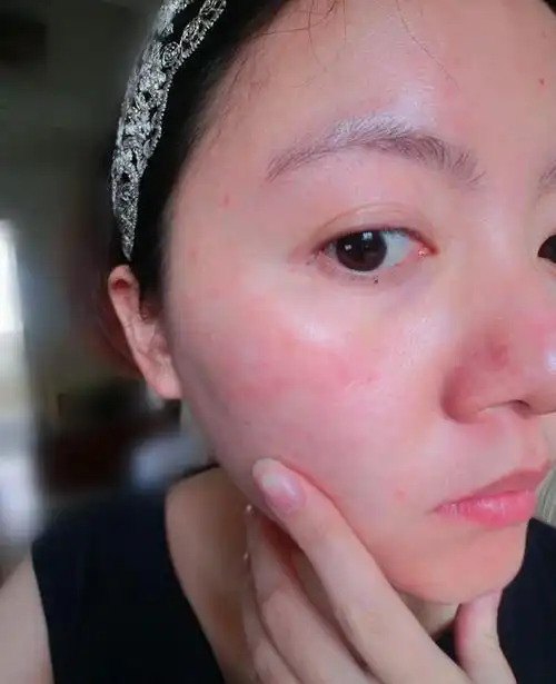 你又过敏了??让皮肤安全过圣诞,枫丹美业给你支招!