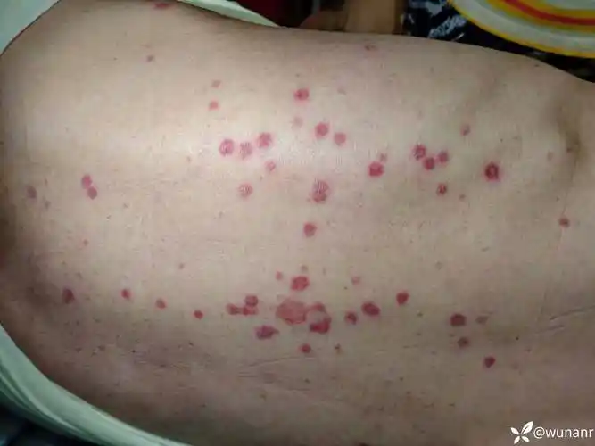 求助|脑梗卧床老年病人后背大面积皮肤红疹
