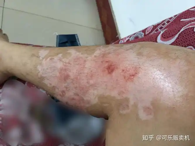 浅二度到深二度烧伤恢复过程记录有图慎点