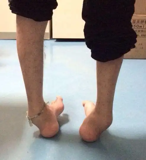 高足弓,除了走不稳,还有大危害