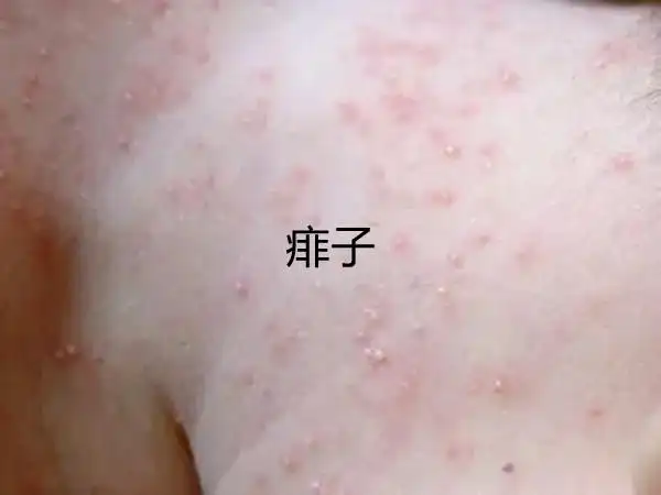 一张图教你区别湿疹和痱子