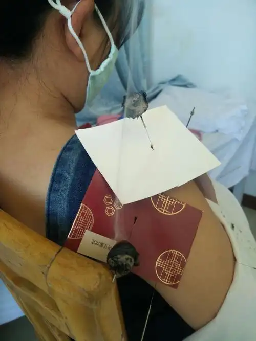 温针灸治疗"漏肩风"