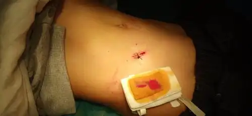 李集镇卫生院微创阑尾炎切出术