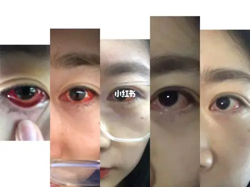 斜视手术恢复 每天都有新变化啦～_美妆_医美_整容_美妆_医美整形