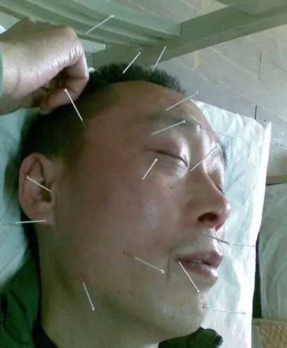 面瘫--中医针灸治疗越早越好