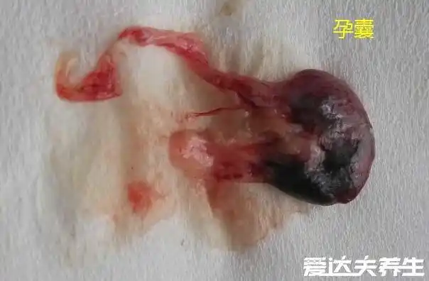 如果药物流产之后没有孕囊的排出,那么药流是失败的,为了比免造成严重