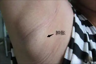 腋下增生可能是皮脂腺囊肿,淋巴结炎等因素引起的,可能会导致患侧肿胀