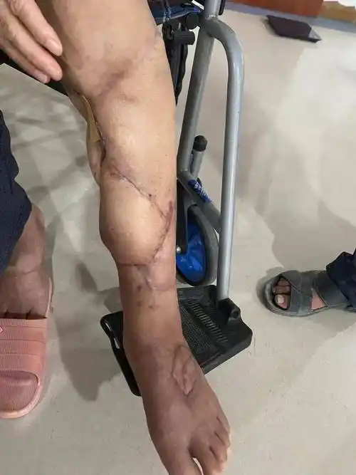 截肢不可能骨科这样保住了宋阿姨的腿