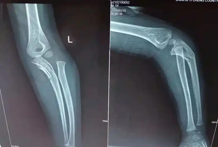 桡骨头向后外方脱位