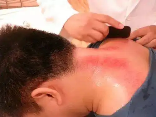一张"刮痧血背照"吓哭网友!厦门医生提醒:出痧并非越多越好