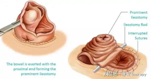 真的有人没肛门那怎么生活你可能从未听闻低位直肠癌的彷徨