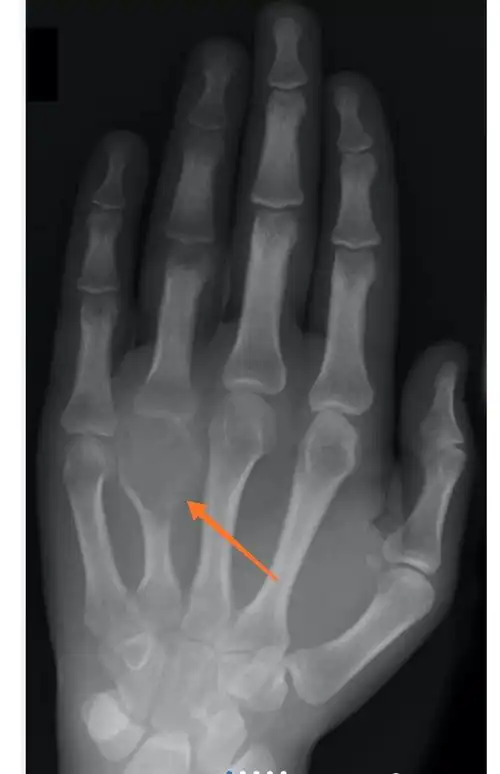 骨巨细胞瘤的少见发病部位