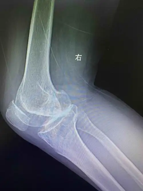 双侧膝外翻病例分享