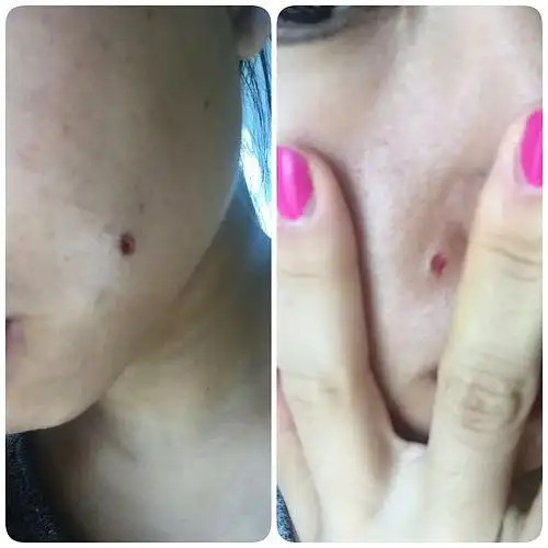 【过两周更9.23】点痣直播 恢复期状况(慎入)