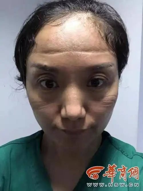 连续工作多个小时后,摘下防护镜和口罩,额头和脸上勒下了深深的压痕