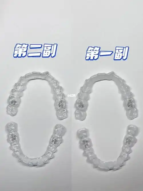 整牙日记|2 of 2307换牙套啦