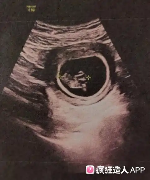 孕9周,有点胎儿形状啦