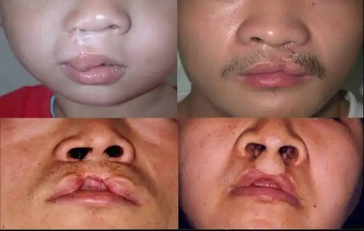 孩子出现唇裂继发畸形多久可以做手术修复